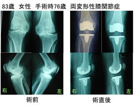 術後7年経過した人工膝関節の良好なレントゲン所見と症状の改善
