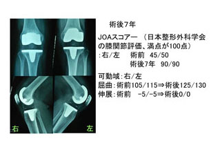 術後7年経過した人工膝関節の良好なレントゲン所見と症状の改善