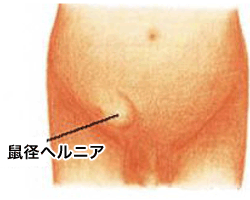 部 腫れ 鼠蹊 ふともものつけ根にふくらみを見つけたらお読みください