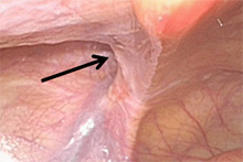 腹腔鏡下ヘルニア手術1