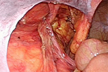 腹腔鏡下ヘルニア手術2