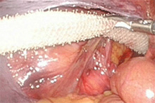 腹腔鏡下ヘルニア手術3