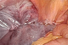 腹腔鏡下ヘルニア手術6