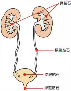 尿路結石の図