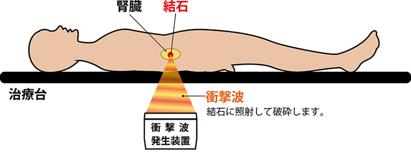 体外衝撃波結石破砕治療(ESWL)の図