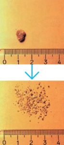 結石破砕前・破砕後